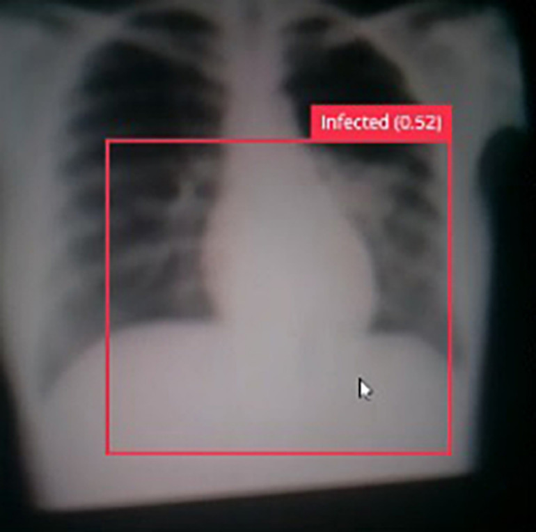 Rysunek 25. Wykrywanie infekcji wirusowej w płucach za pomocą zdjęcia rentgenowskiego
