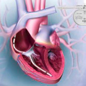 Aktywne implanty okiem inżyniera medycznego